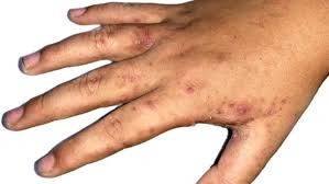 ছড়িয়ে পড়ছে স্ক্যাবিস